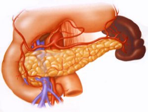 Cancerul pancreasului endocrin