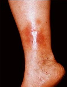 Ulceratie picior