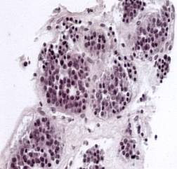aspectul-anatomopatologic-pledeaza-pentru-diagnosticul-de-tumora-carcinoida-tipic-celule-mici-rotunde-uniforme-cu-mitoze-rare-reactie-desmoplazica-intensa