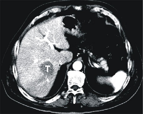 metastaza-hepatica-din-cancer-de-colon-de-5-cm-situata-in-segmentul-vii-t-tumora