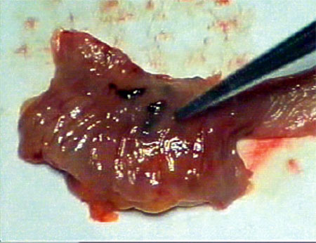 varice-ectopic-intestinal-piesa-operatorie-sectionata